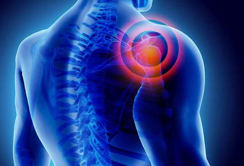 frozen-shoulder-s1-what-is-it